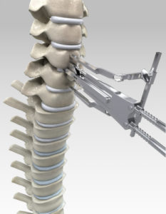 spinal fusion surgery patient reviews