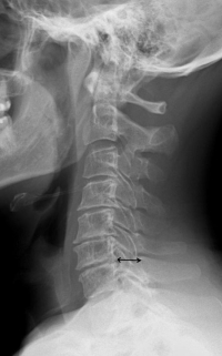 spinal fusion surgery patient reviews