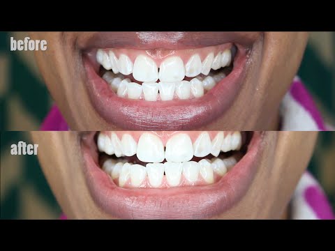 molr charcoal teeth whitening reviews